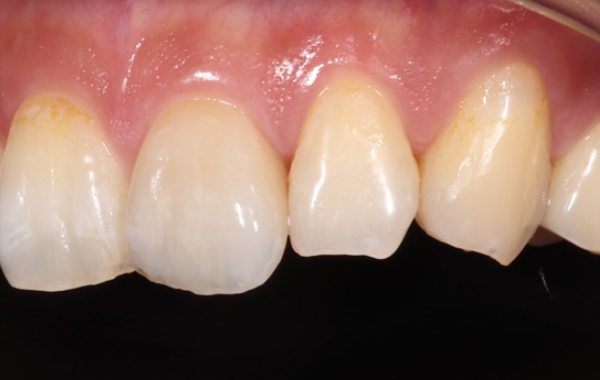審美歯科の治療前の写真