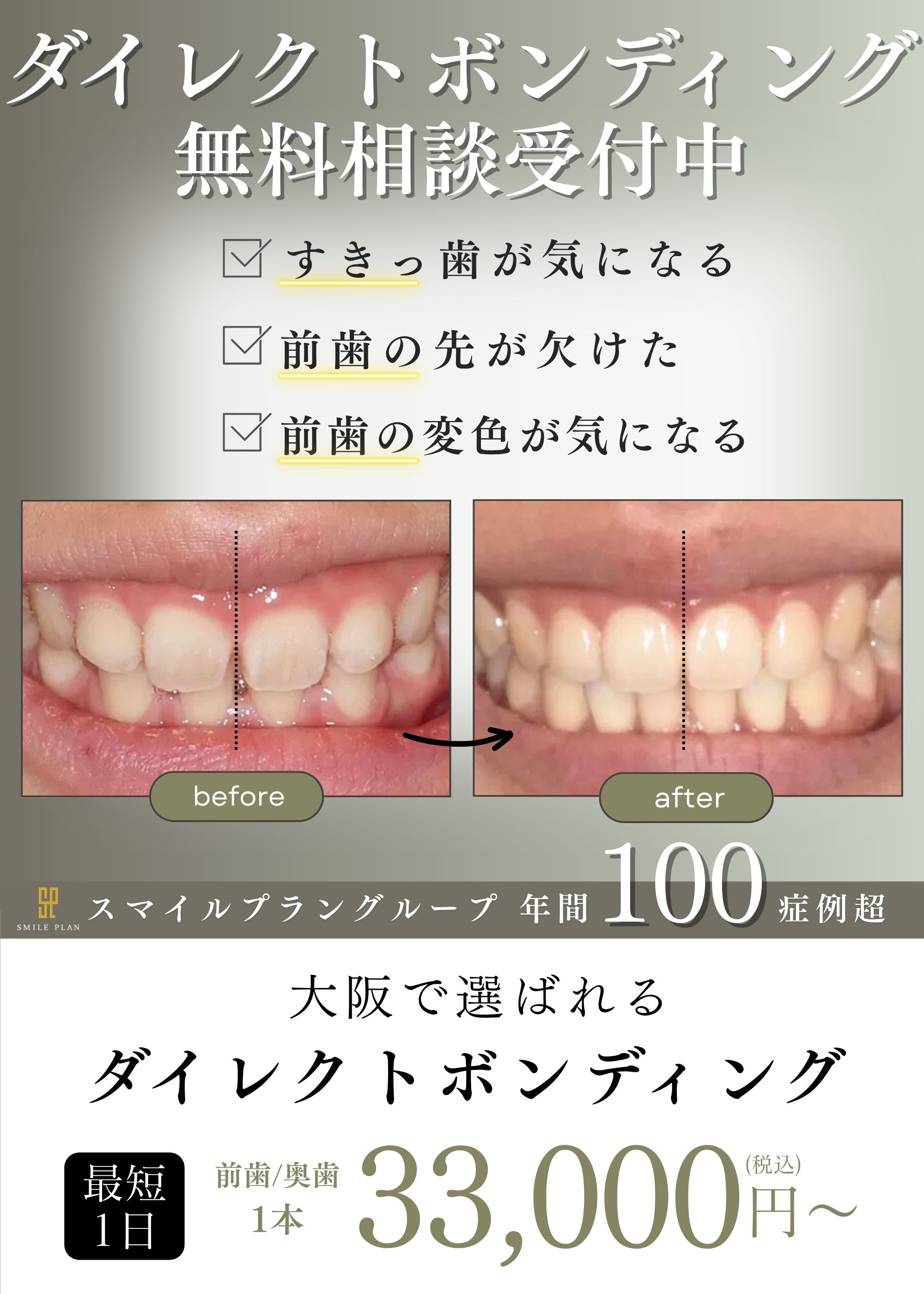 最高品質ダイレクトボンディング  高槻で満足度★5