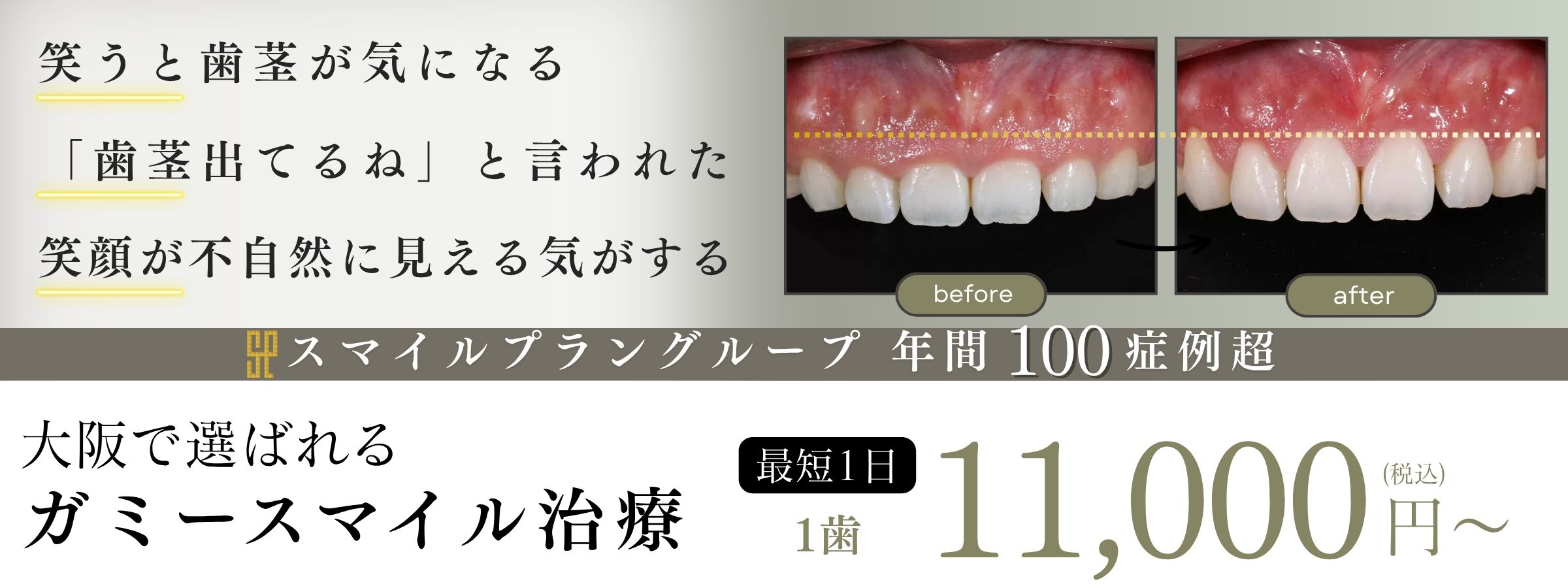 高槻のガミースマイル名医・最短1日1万円