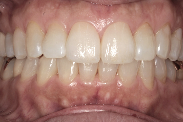 審美歯科の治療後の写真