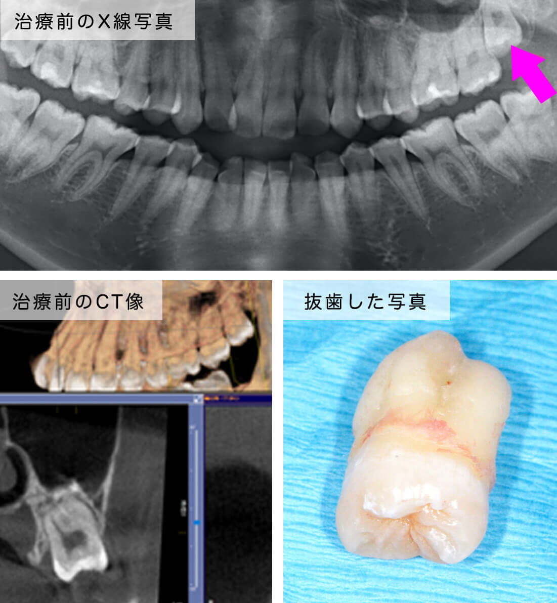 親知らず 抜歯 後 手前 の 歯 が 痛い