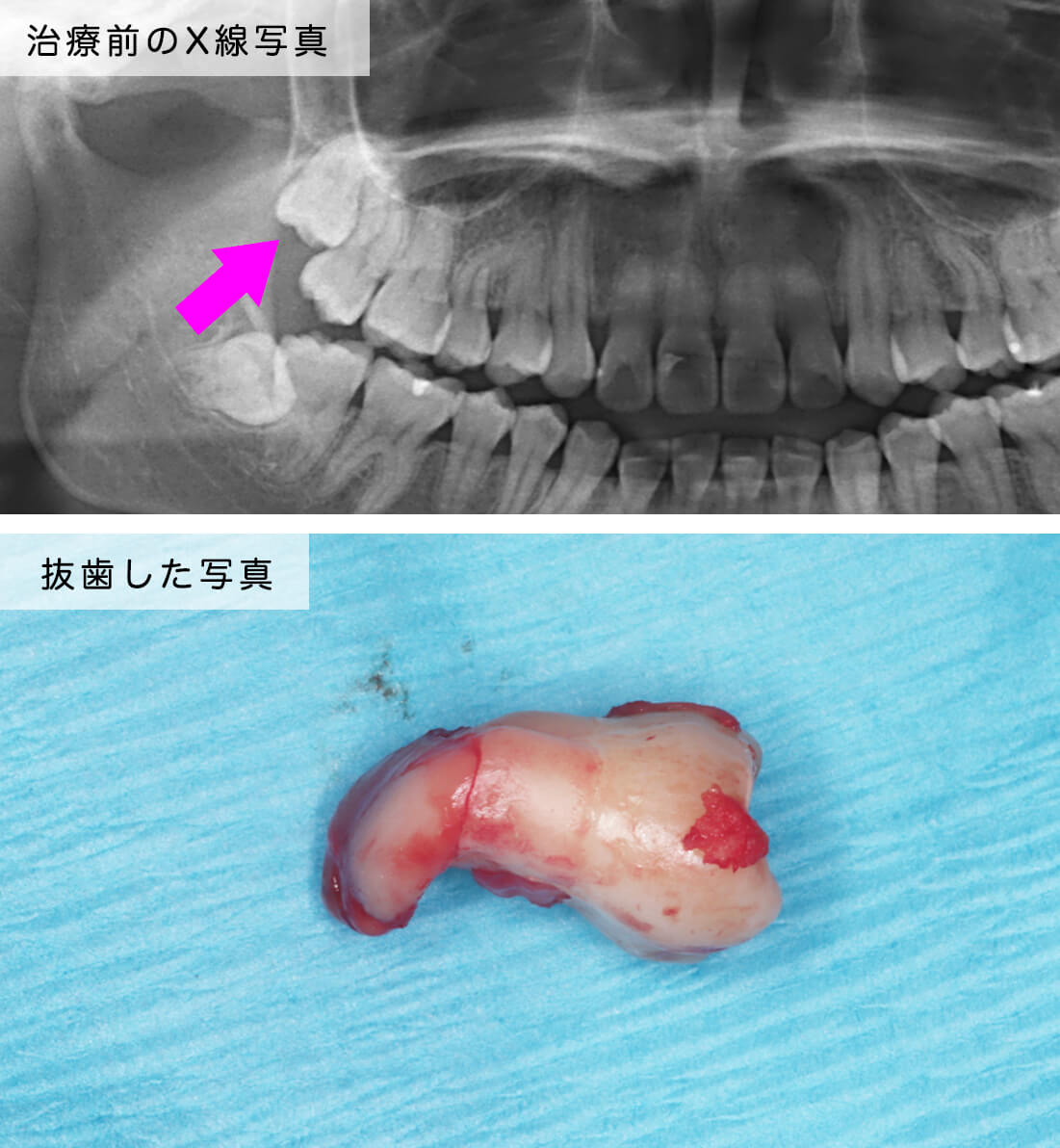 親知らず 手前 の 歯