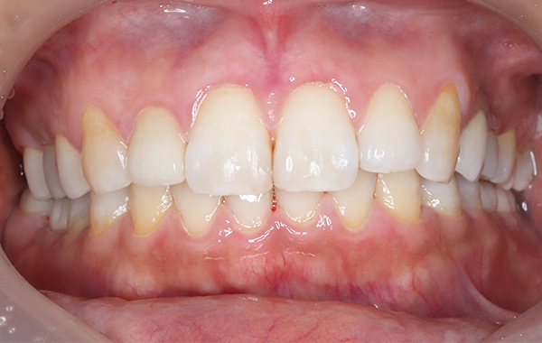 審美歯科の治療前の写真